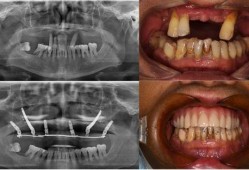 佛山种牙爆料事件最新情况