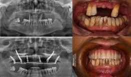 佛山种牙爆料事件最新情况