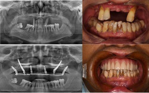 佛山种牙爆料事件最新情况
